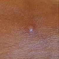 Image of monkeypox lesion